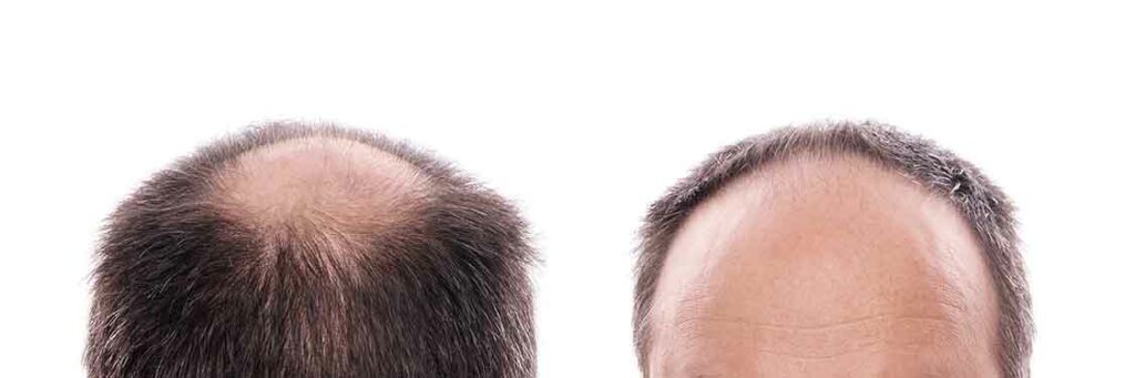 Saç Dökülmesi Neden Olur? Sebepleri Nelerdir? | HospitalTürk